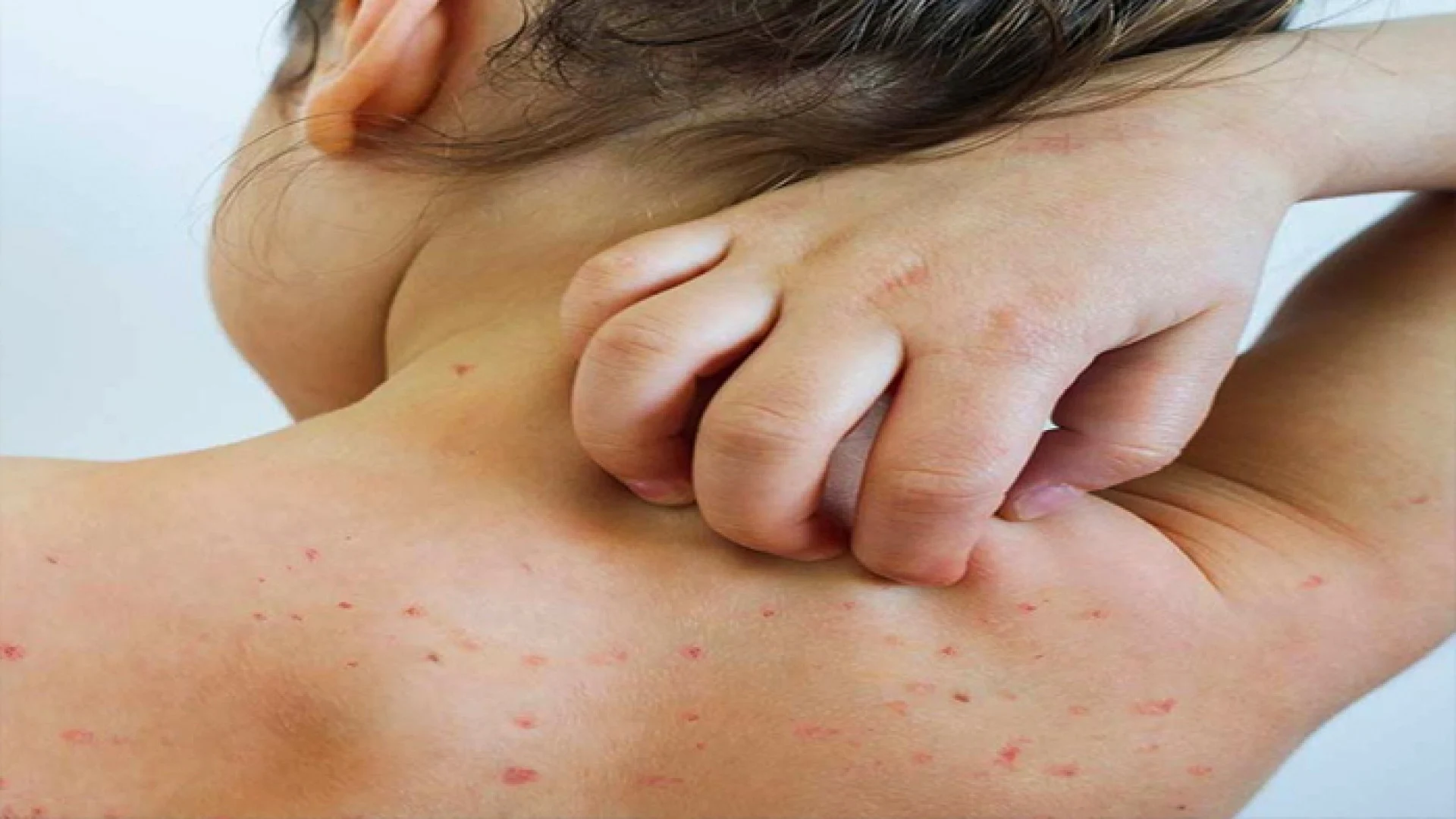 হামে আরও ৪ জনের মৃত্যু, নতুন শনাক্ত ৬৮৫