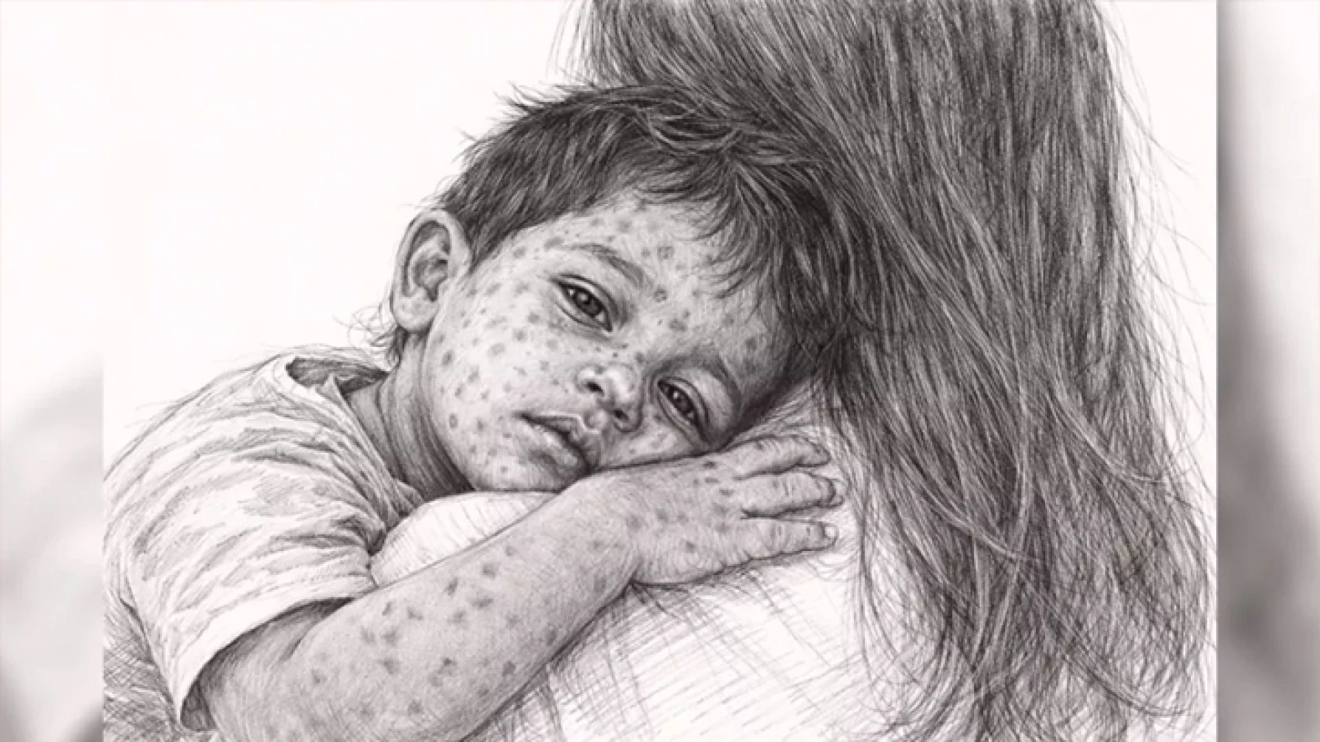 দেশে হাম ও হামের উপসর্গ নিয়ে আরও ৮ শিশুর মৃত্যু