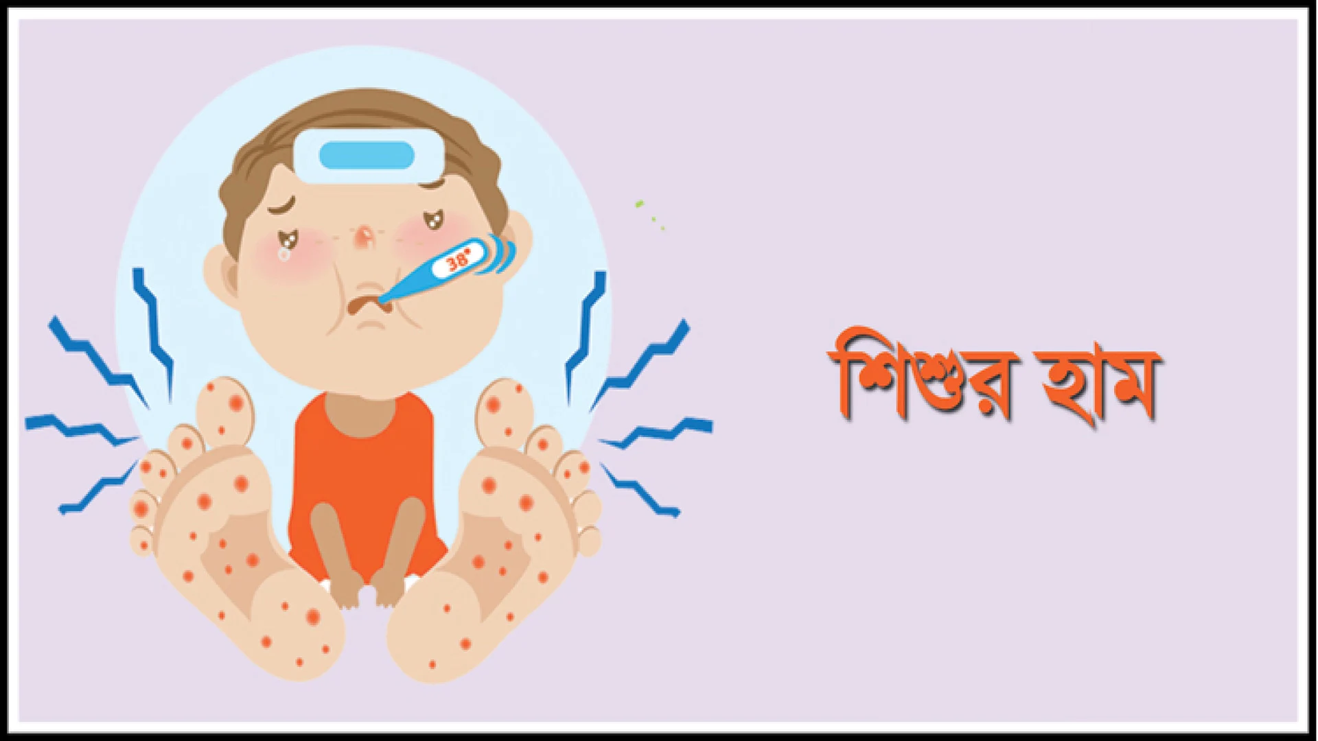 হামের উপসর্গ নিয়ে আরও ৭ শিশুর মৃত্যু, আক্রান্ত ১৫১৮