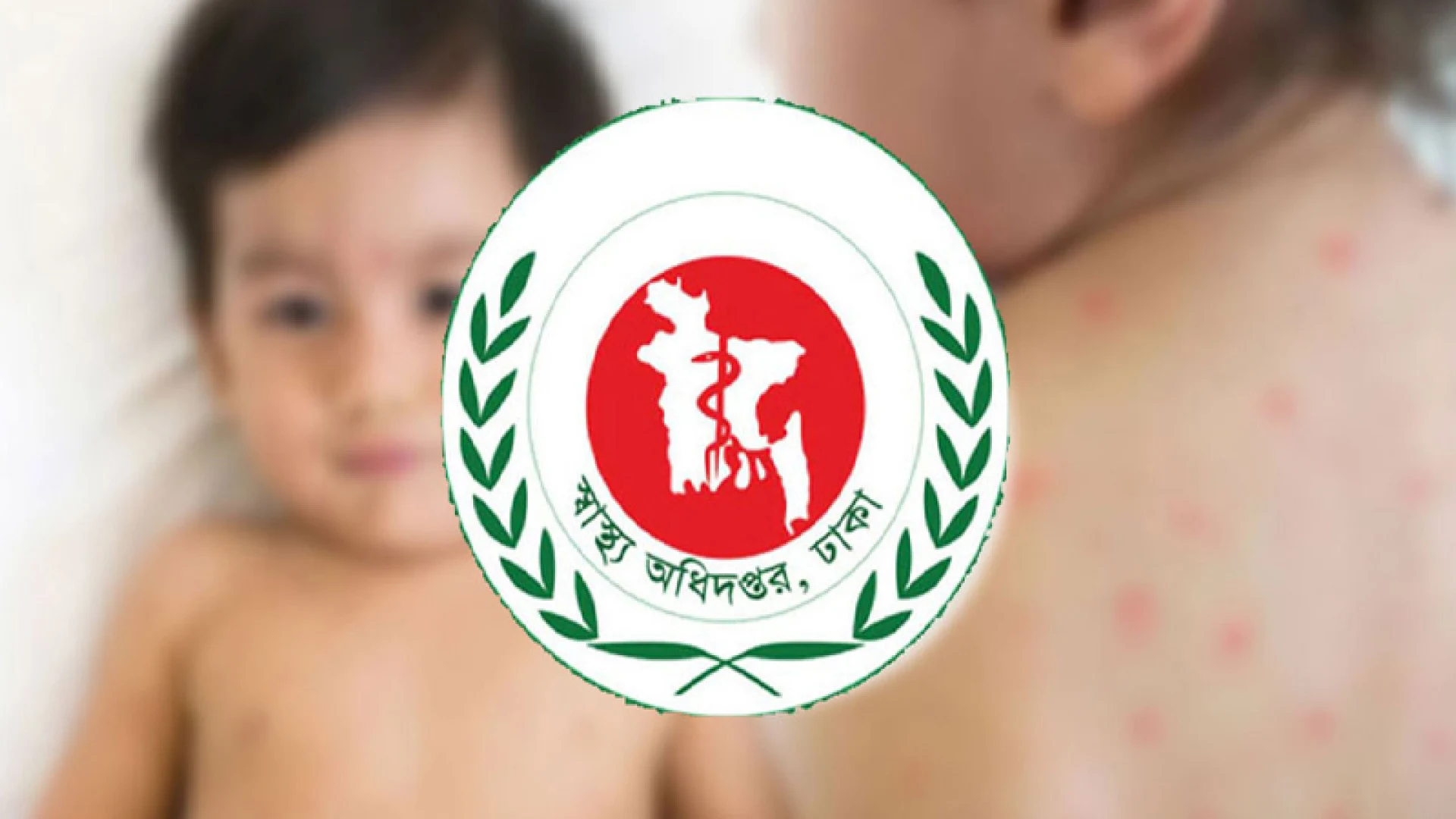 হামের উপসর্গে  ১৭ শিশুর মৃত্যু, নতুন আক্রান্ত ১২২৪