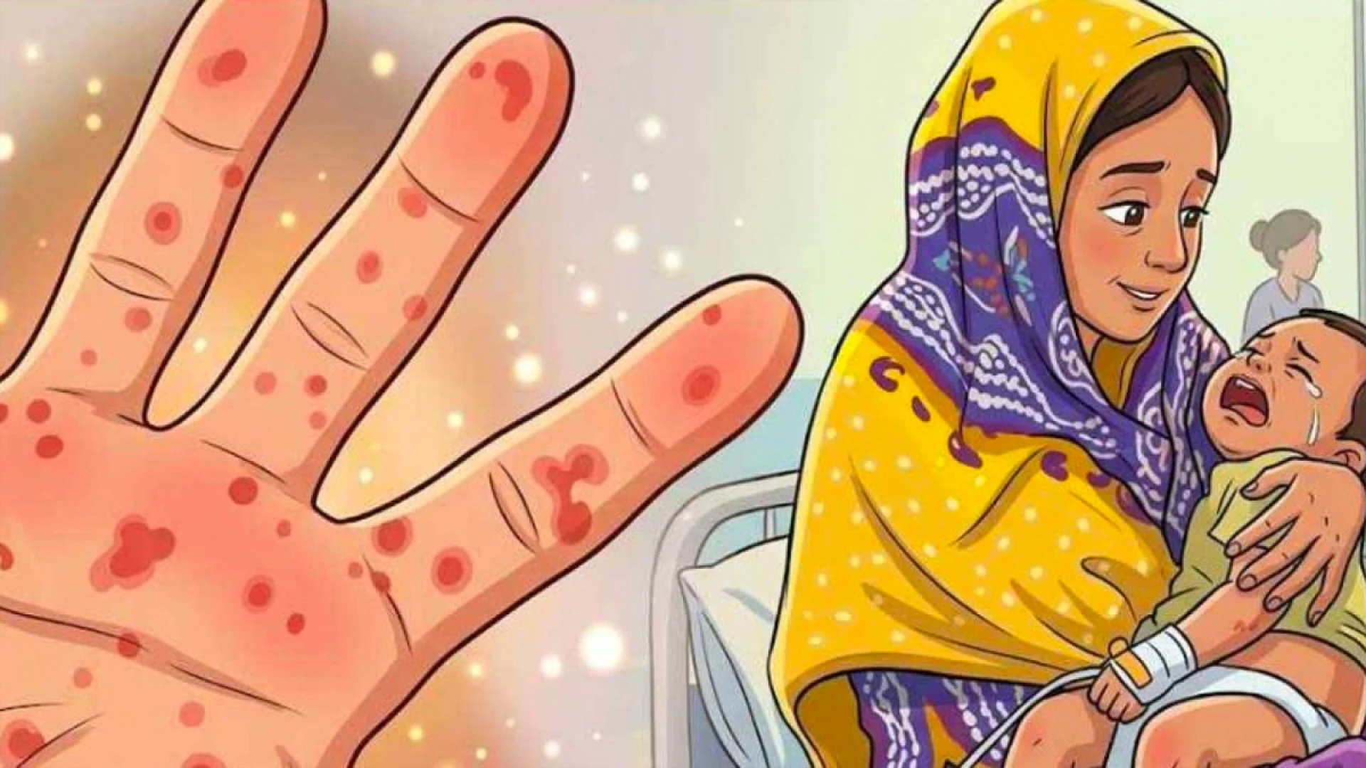 হামের উপসর্গে আরও তিন শিশুর মৃত্যু