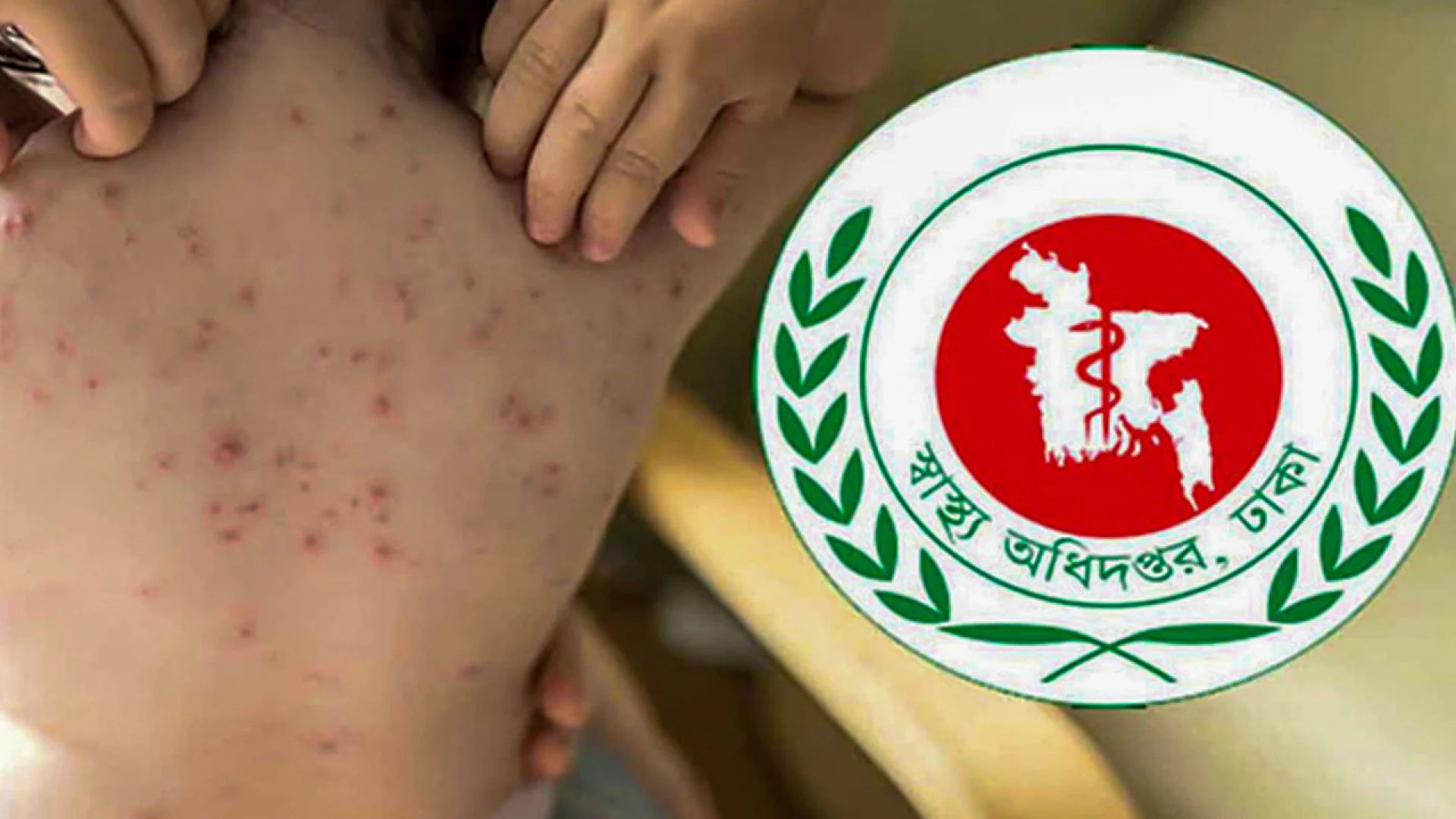 হামের উপসর্গে আরও ৩ জনের মৃত্যু, নতুন আক্রান্ত ৯০১