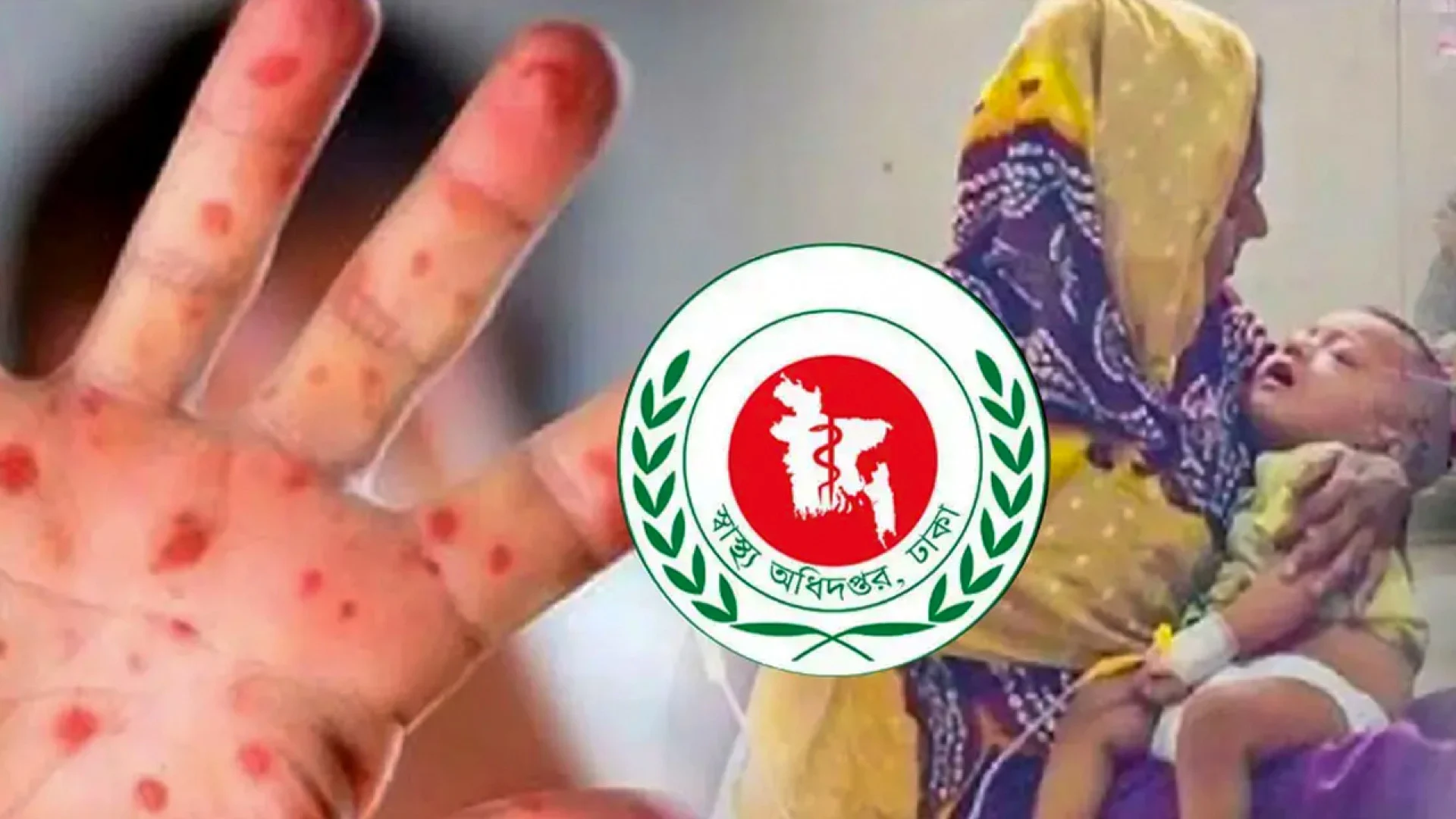 হামের উপসর্গে আরও ৫ শিশুর মৃত্যু, আক্রান্ত ১০৬৯
