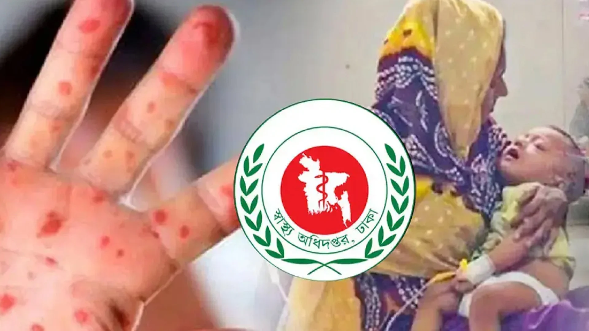 দেশে ২৪ ঘণ্টায় সন্দেহজনক হাম রোগী ৮৭২, মৃত্যু ২