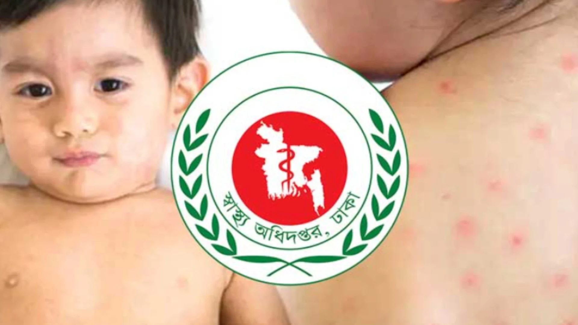 হামের উপসর্গে ২৪ ঘণ্টায় আরও ৬ জনের মৃত্যু, নতুন আক্রান্ত ১,২৫৬