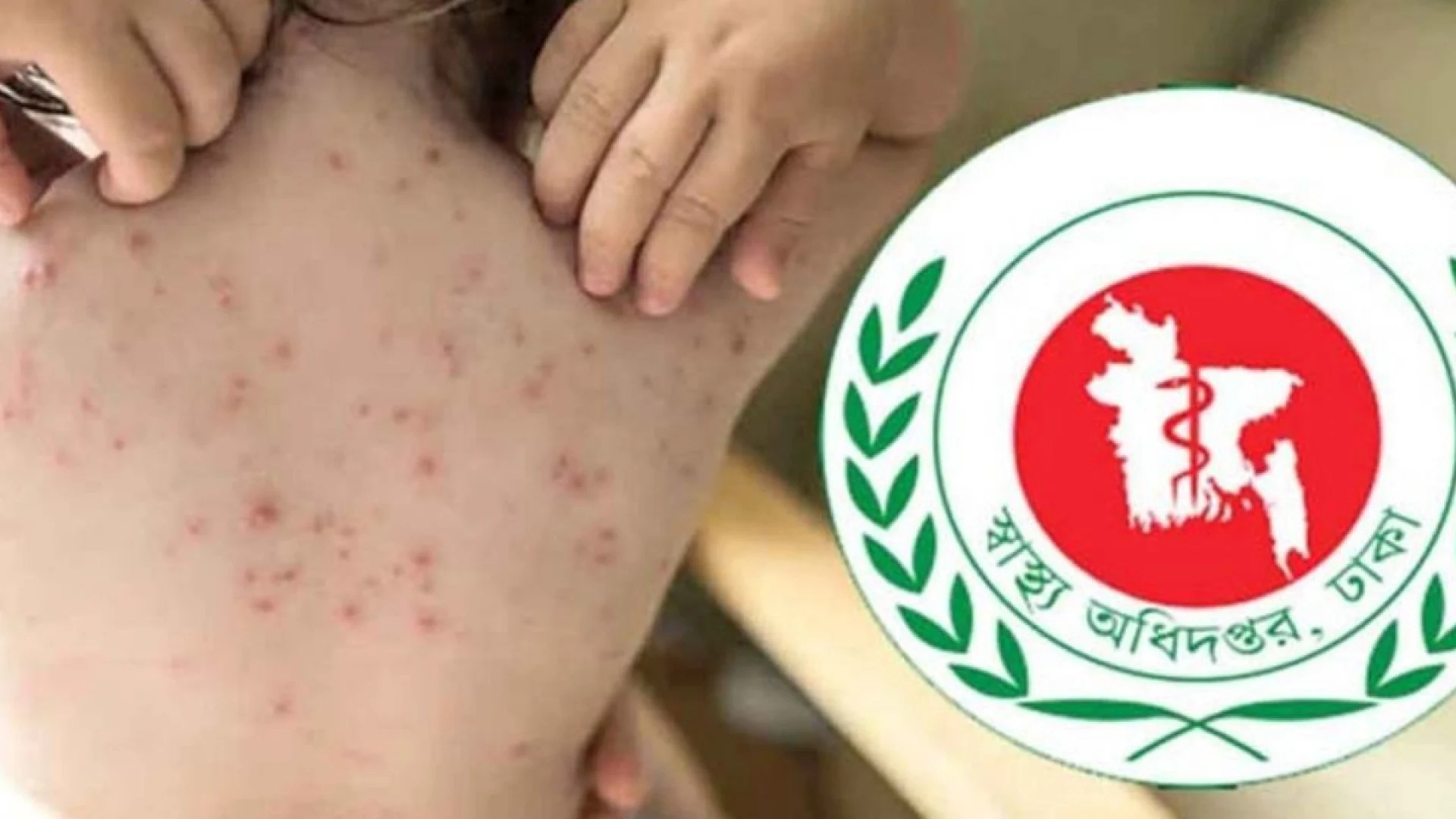 হামের উপসর্গে আরও ৬ মৃত্যু, একদিনে হাসপাতালে ১,৩১৬ রোগী