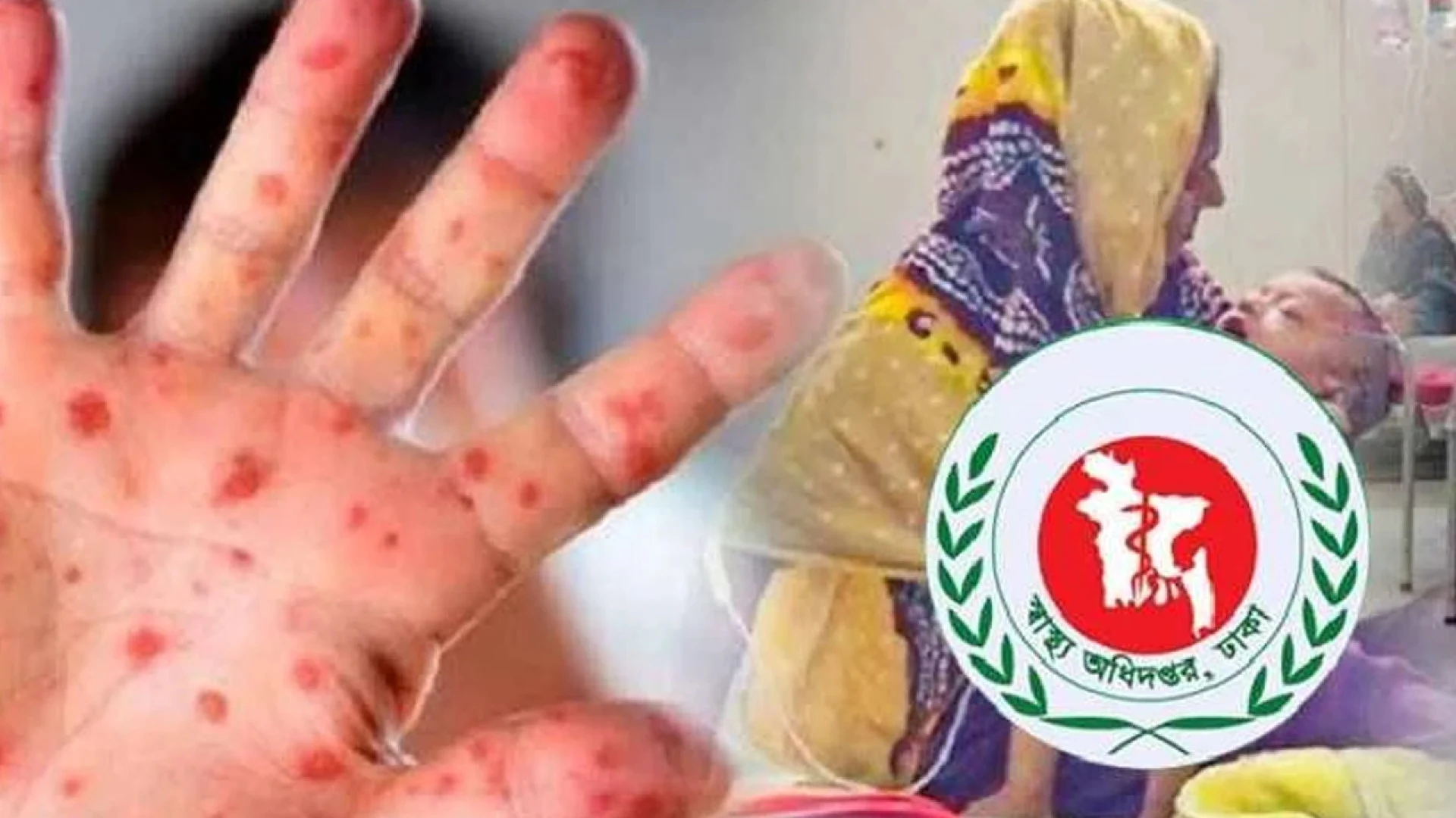 হামের উপসর্গে ২৪ ঘণ্টায় আরও ১১ মৃত্যু, আক্রান্ত ১,২৭০