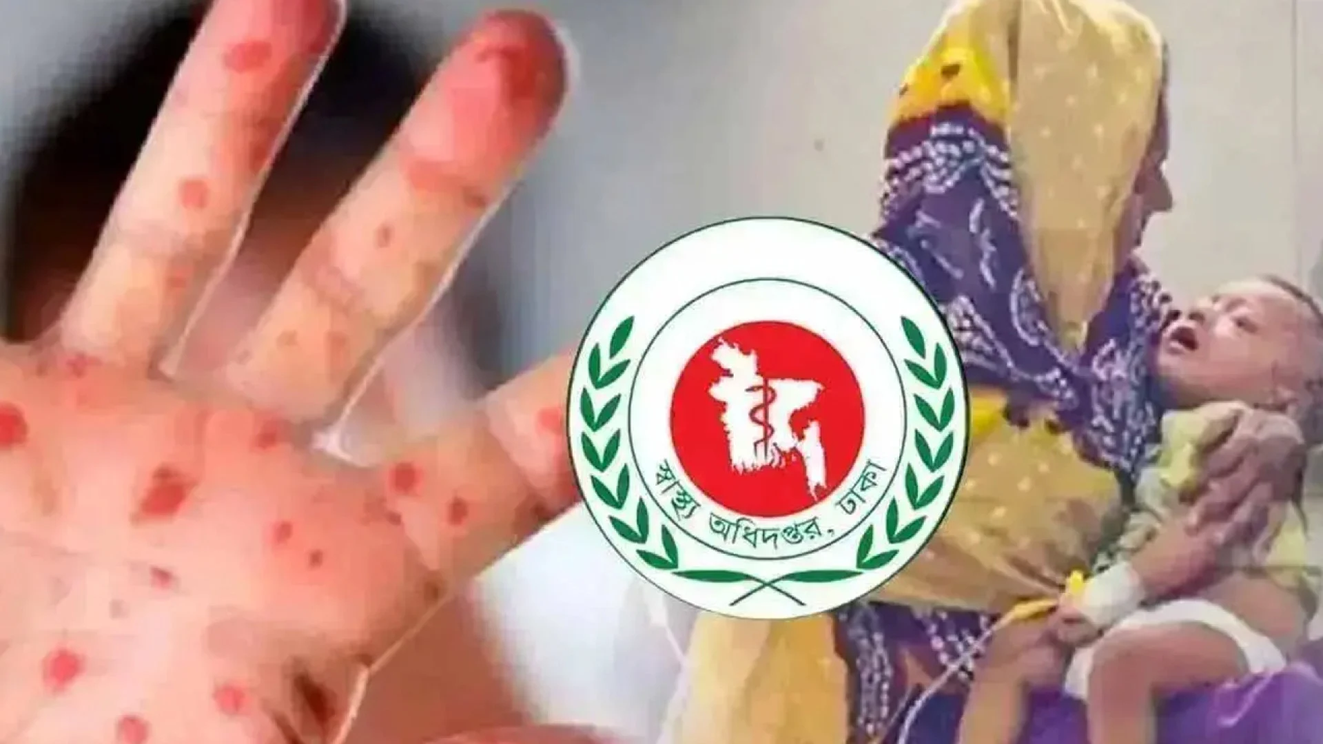 হামের উপসর্গে আরও ৩ মৃত্যু, একদিনে হাসপাতালে ১,৩০০ রোগী