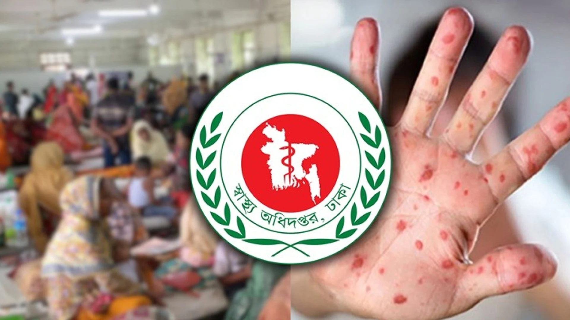 হামে আরও ৬ মৃত্যু, একদিনে হাসপাতালে ভর্তি ১,৩৯০