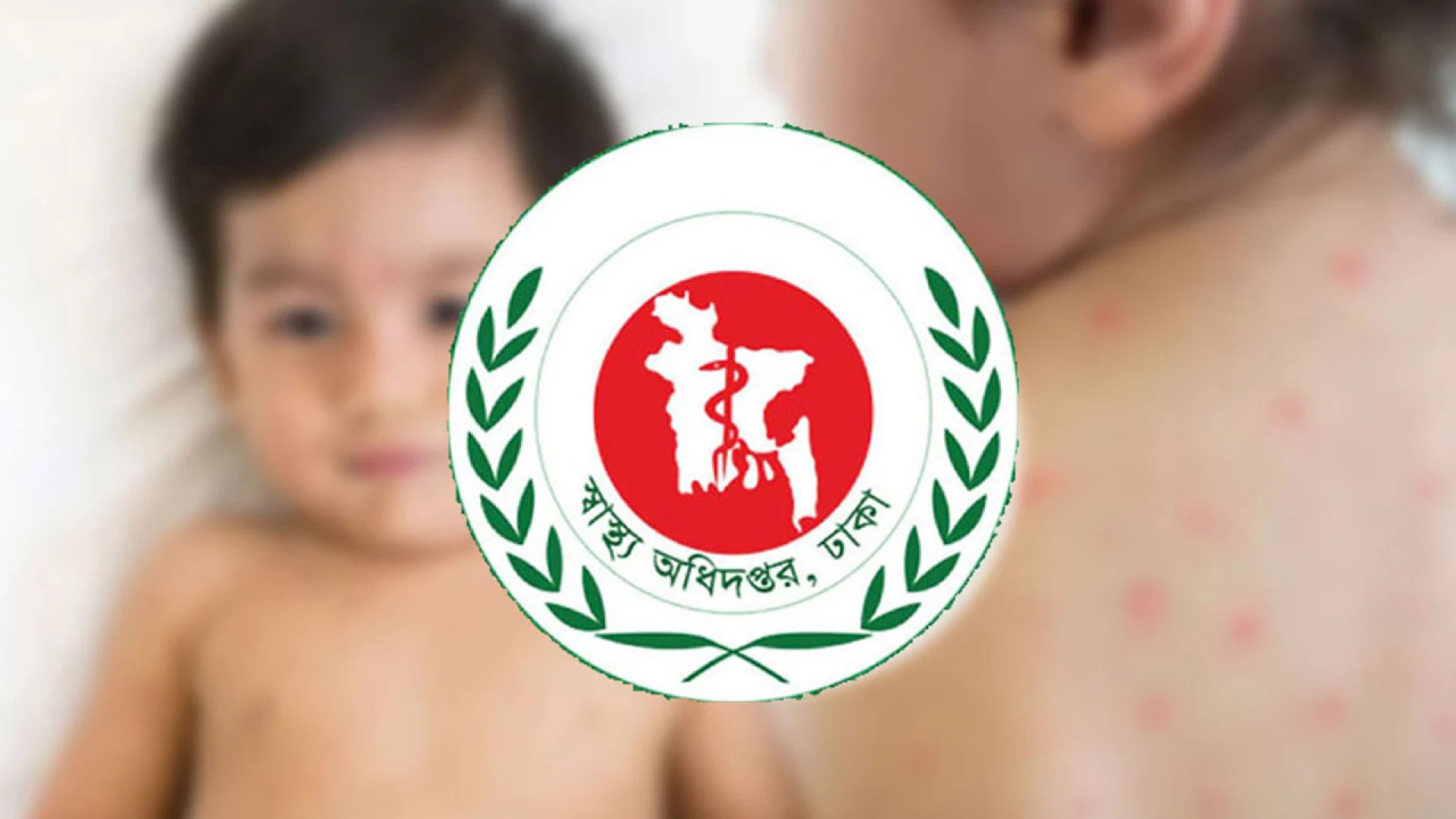 দেশে ২৪ ঘণ্টায় হামের উপসর্গ নিয়ে ৫ জনের মৃত্যু, নতুন রোগী ১,২১০