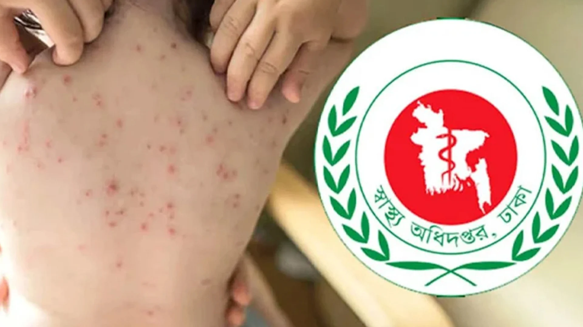 দেশে হাম ও উপসর্গে মৃত্যুর সংখ্যা ১২০১, নতুন রোগী ১৩৪২