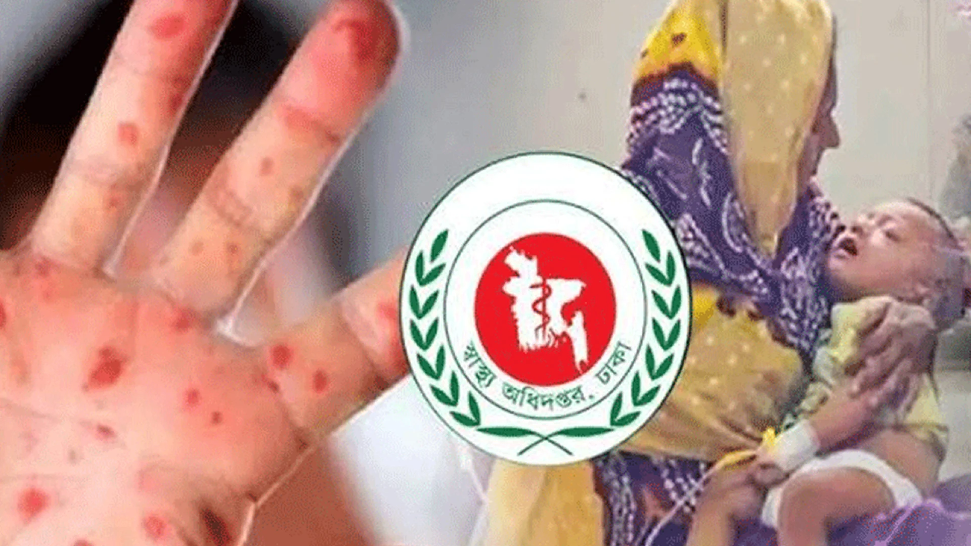 হামের উপসর্গে আরও ৭ জনের মৃত্যু, মোট মৃত্যু ১২১৪
